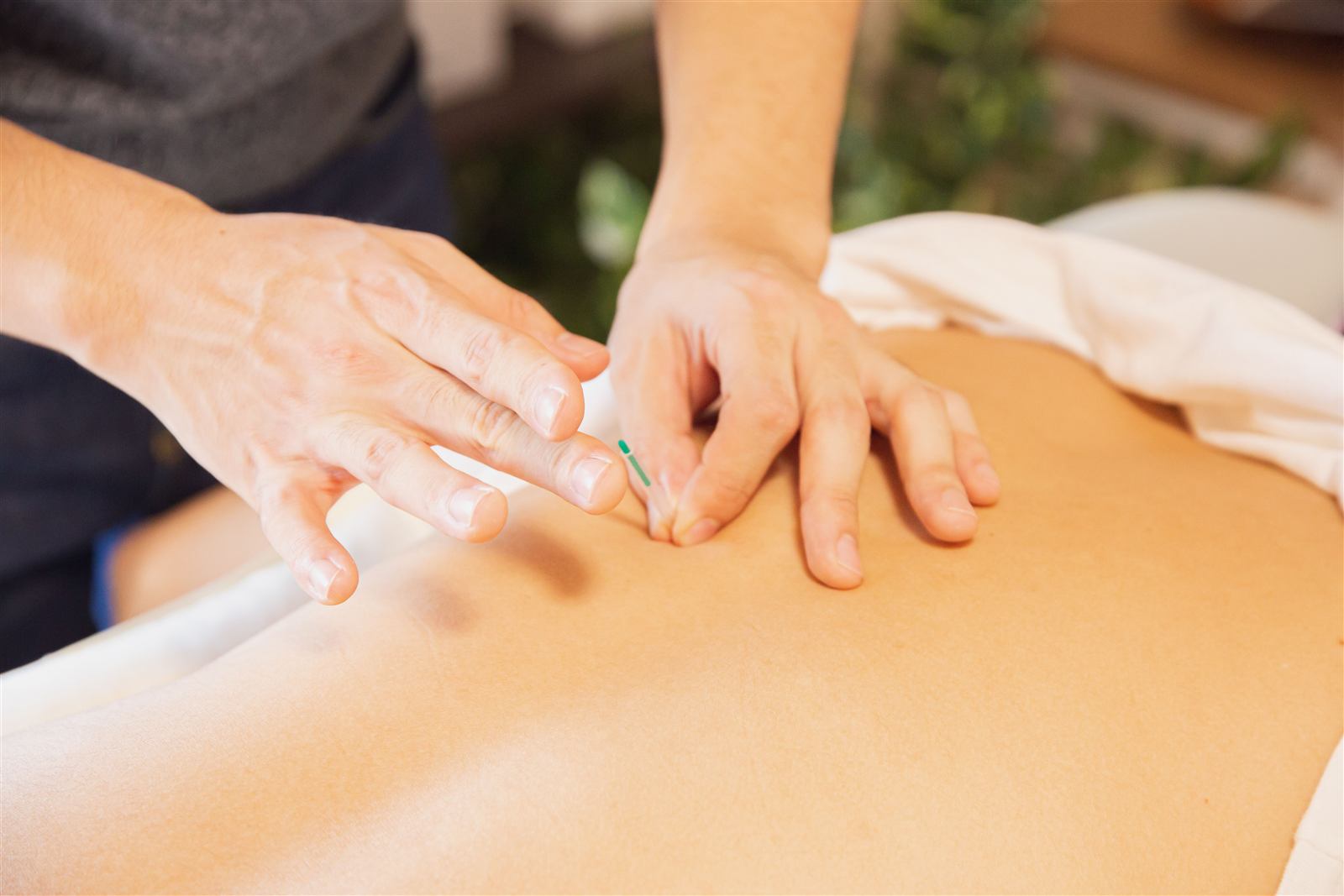 Dry needling treatment being applied to a patient's back